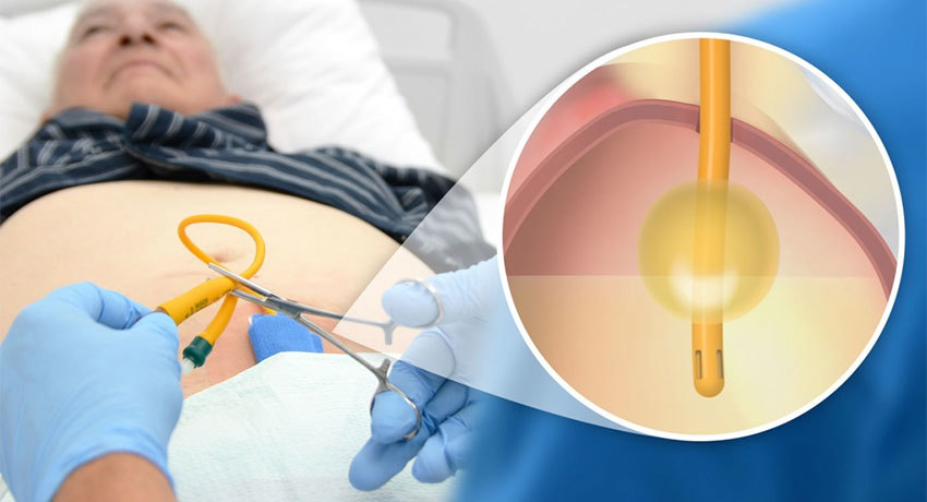 Эпицистостомия