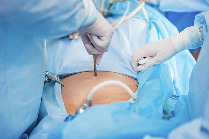 Лапароскопическая операция