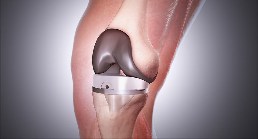 Эндопротез коленного сустава