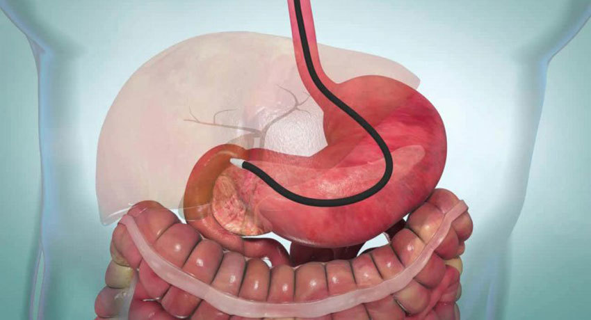 Эндоскопическая папиллосфинктеротомия