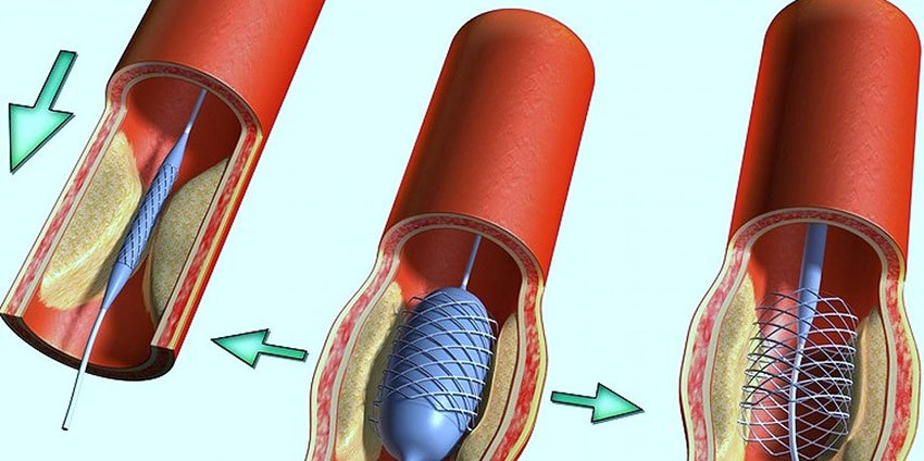 Эндоваскулярная хирургия сосудов