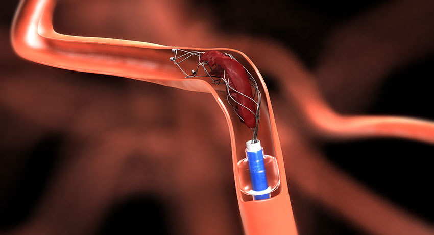 Эндоваскулярное лечение тромбоза