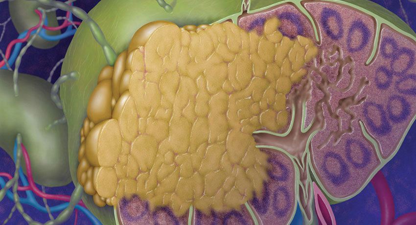 Фолликулярная лимфома