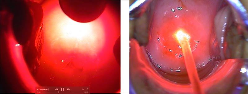 fotodinamicheskaya-terapiya
