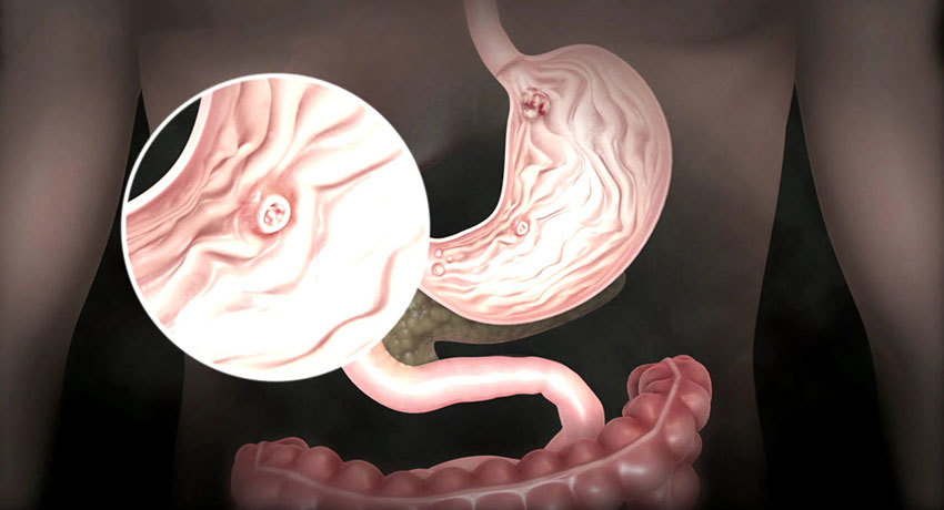 Рак желудка