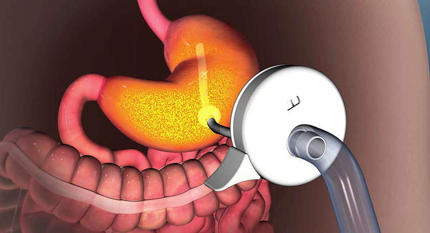 Как выглядит гастростома