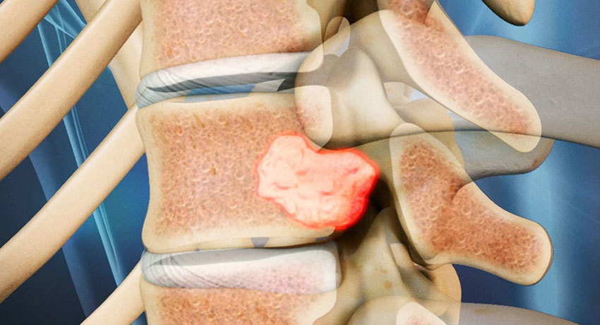 Гемангиома позвоночника