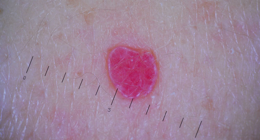 Гемангиома