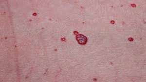 гемангиомы