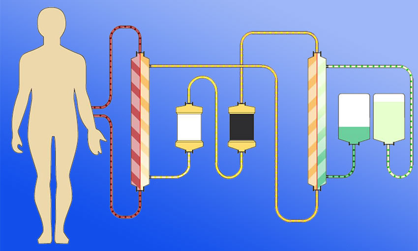 Схема проведения гемодиализа