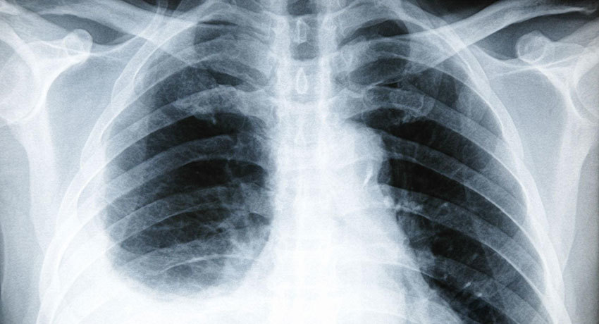 Жидкость в лёгких