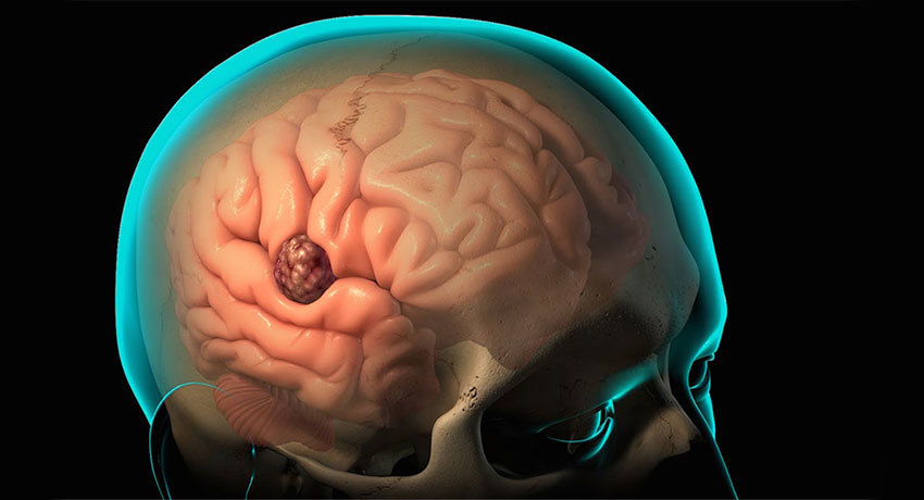 Глиома головного мозга