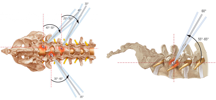 Эндоскопическая операция при межпозвоночной грыже
