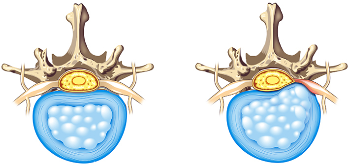 Грыжа позвоночника