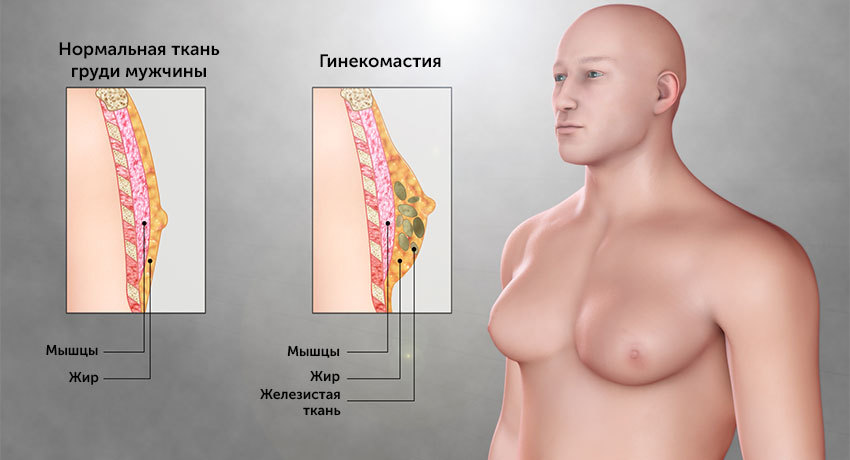 Лечение гинекомастии