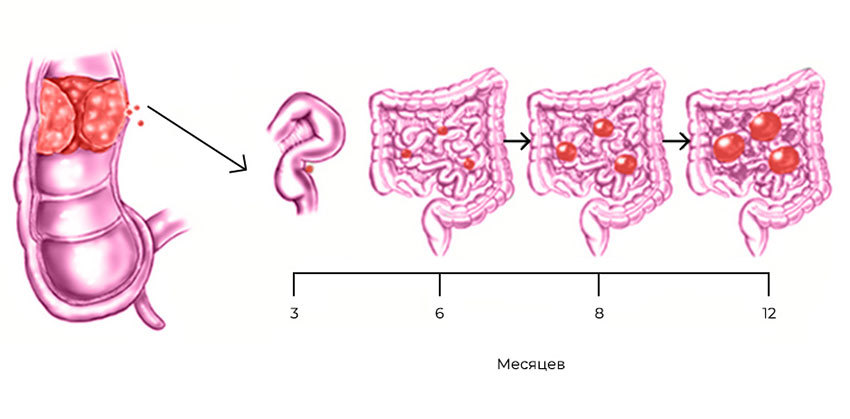 Развитие канцероматоза при колоректальном раке: из прямой кишки в брюшную полость