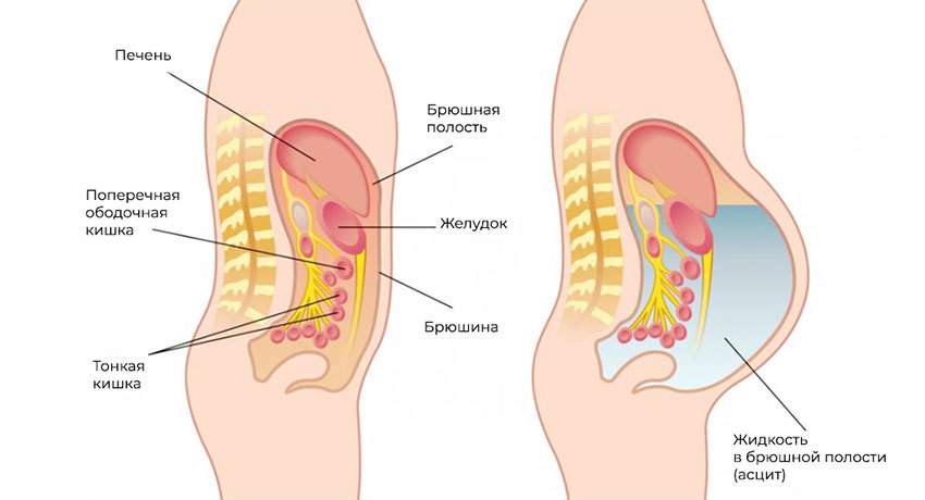 Асцит – скопление жидкости в брюшной полости
