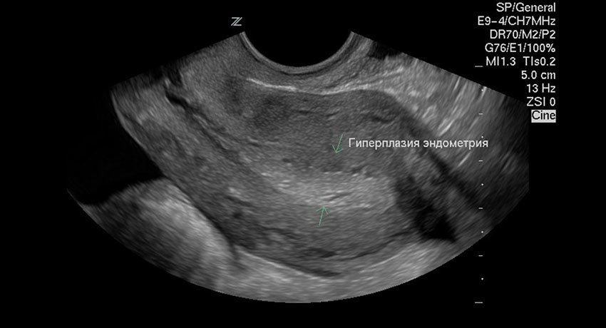 Гиперплазия эндометрия на УЗИ