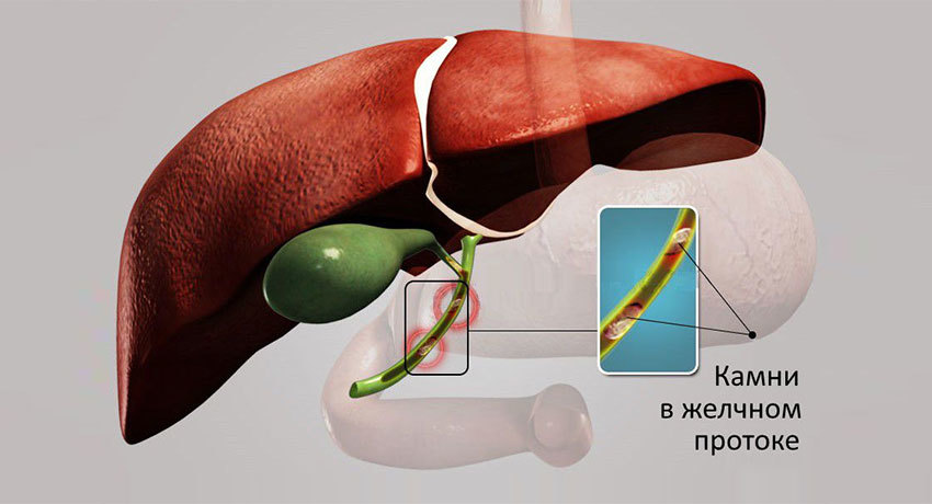 Лечение холедохолитиаза