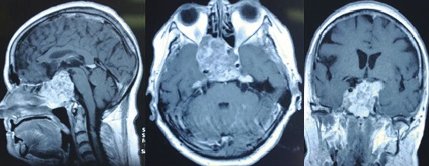 Хордома в черепе