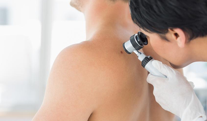 immunoterapiya-melanoma