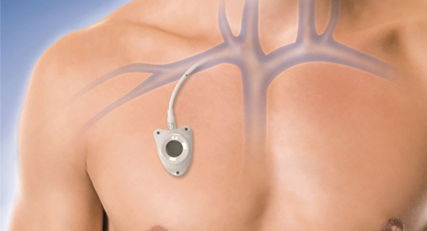 Инфузионная порт-система