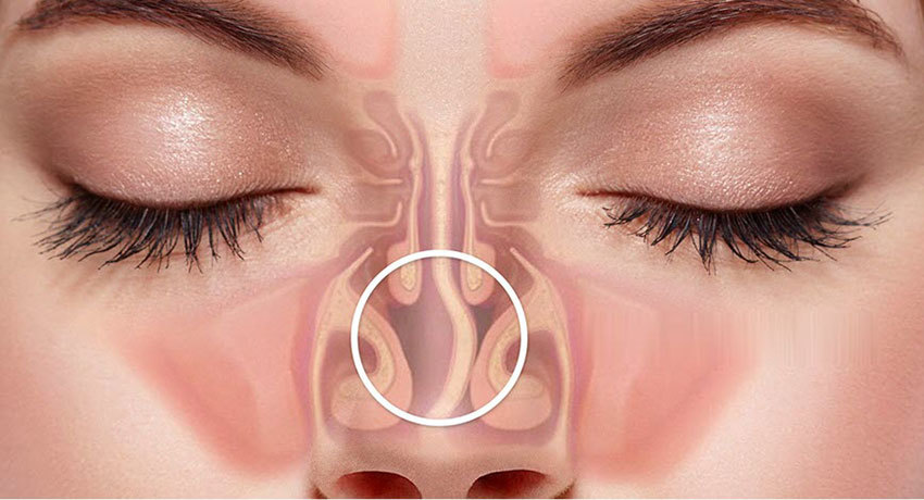 Искривление носовой перегородки