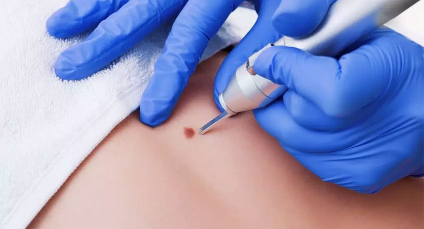 Иссечение опухолей кожи