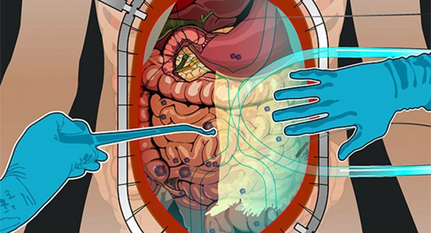 kanceromatoz-bryushiny-20072020