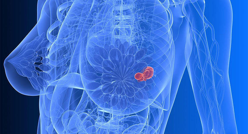 Карцинома молочной железы