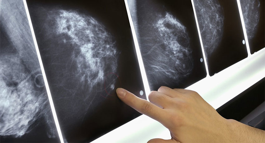 Лечение карциномы молочной железы