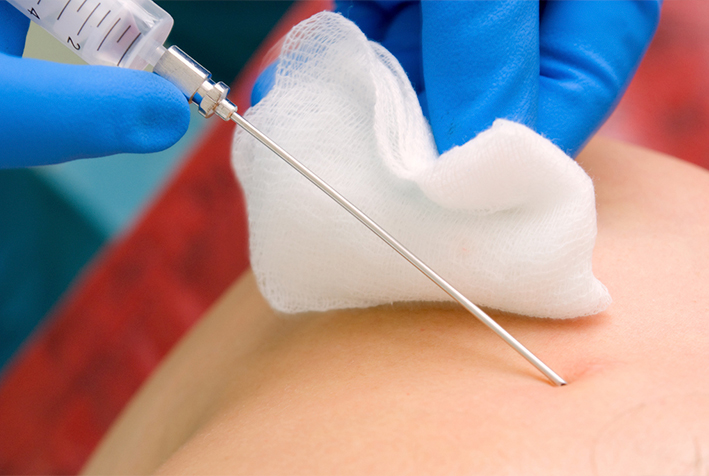 kista-molochnoj-zhelezy-punktirovanie