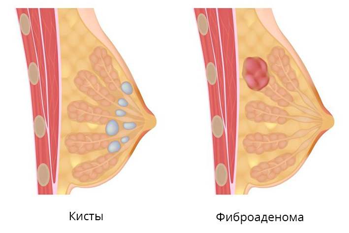 kisty-molochnoj-zhelezy