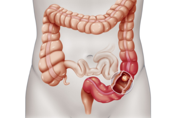 рак у мужчин3