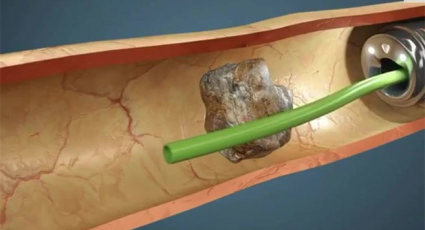 Контактная лазерная литотрипсия