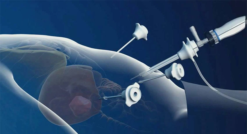 Лапароскопическая операция