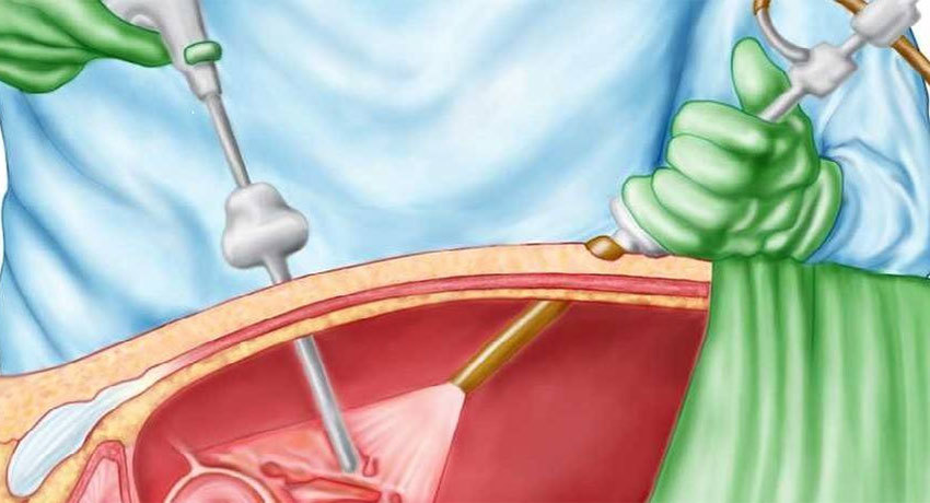 Лапароскопия в гинекологии