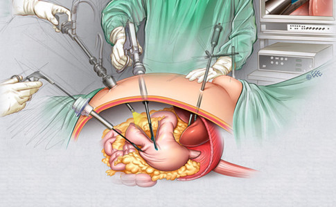laparoskopicheskaya-gastrektomiya