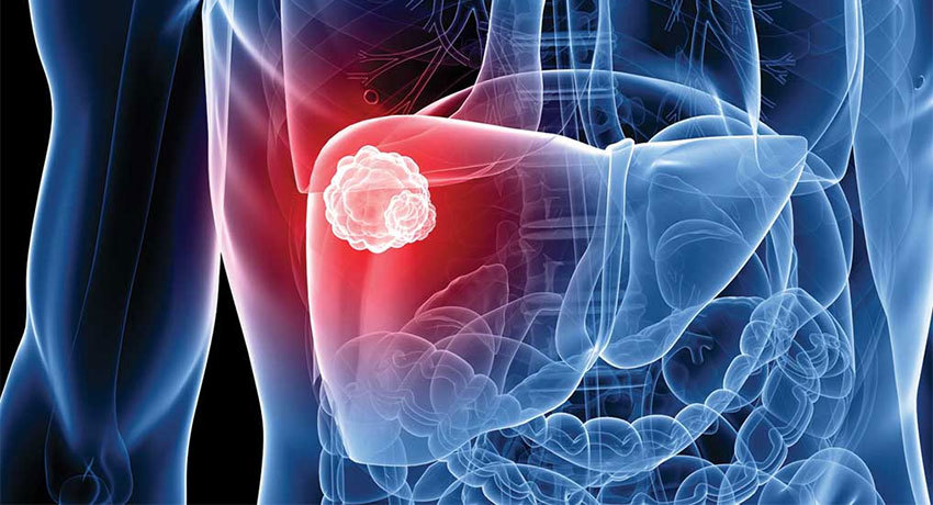 Лечение рака печени