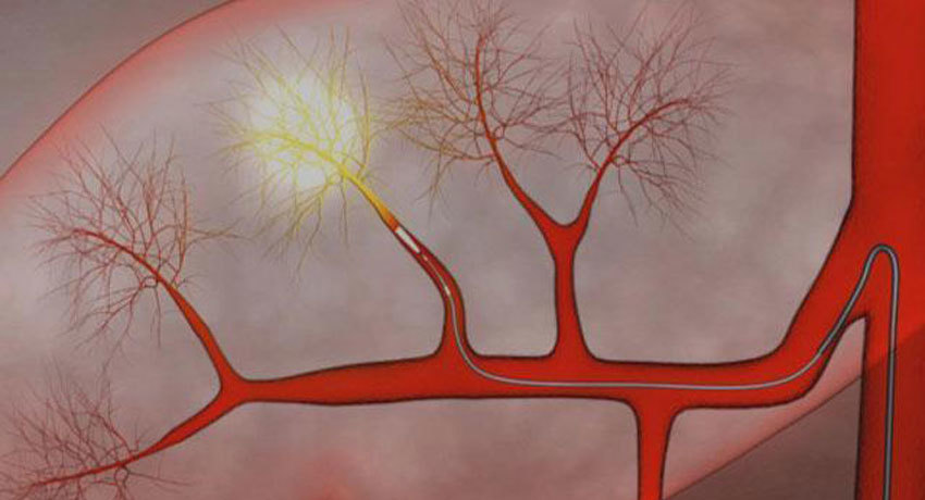 Эмболизация печени