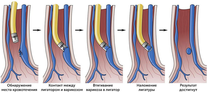 Лигирование вен пищевода