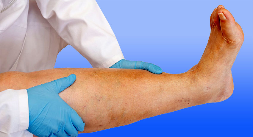 Лечение лимфостаза