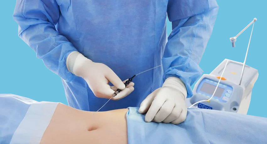 Липосакция