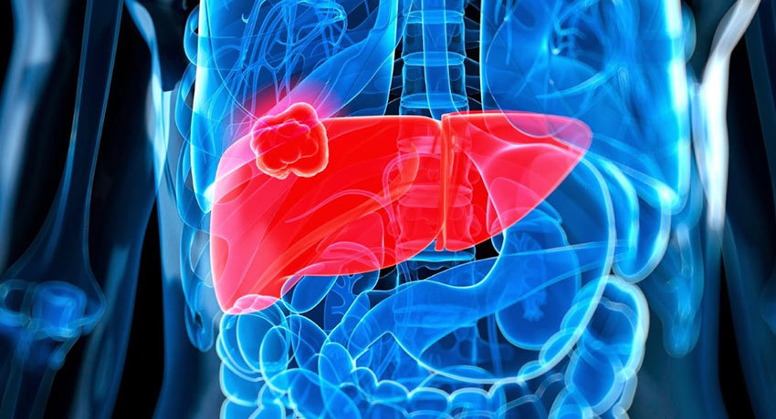 Гепатоцеллюлярный рак печени