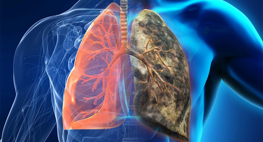 Показания для лобэктомии легкого