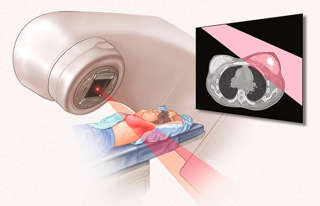 luchevaya-terapiya-mastektomiya