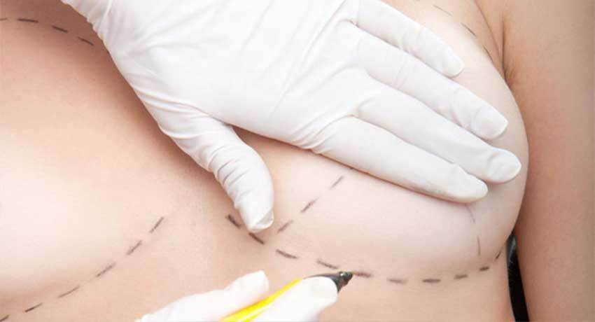 Мастэктомия с реконструкцией молочной железы