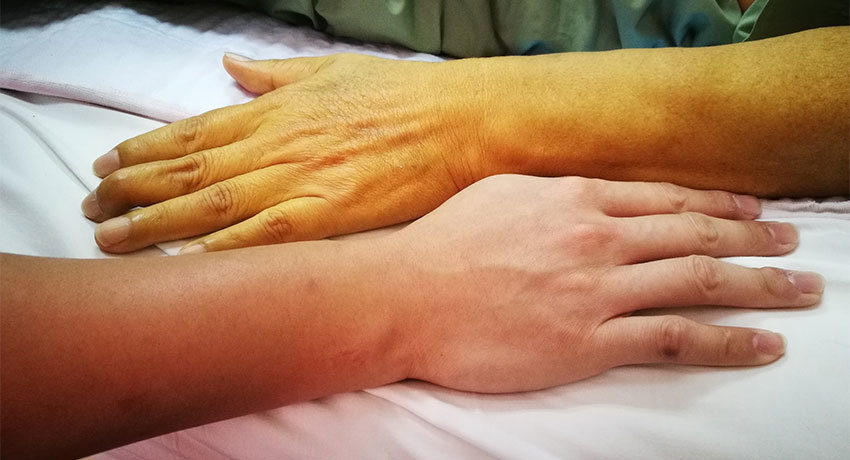 Симптомы механической желтухи