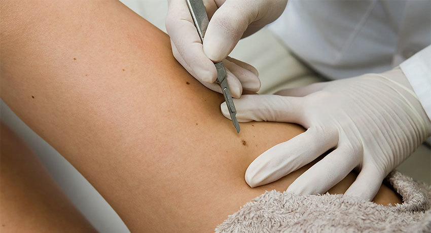 Лечение меланомы