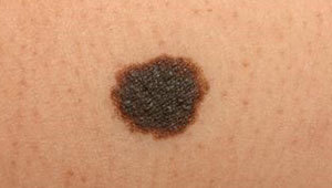 меланоцитарные-невусы